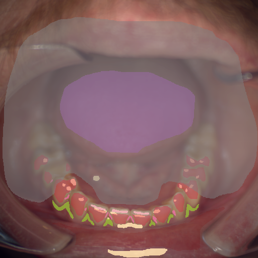 False color image render of a spectral image exhibiting attrition/erosion, calculus, enamel, marginal gingiva, oral mucosa, out of focus area, specular reflection and tongue