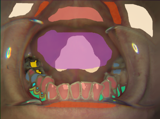False color image render of a spectral image exhibiting attached gingiva, dentine caries, enamel, lip, marginal gingiva, metal, microfracture, plastic, root, skin, soft palate, specular reflection and tongue
