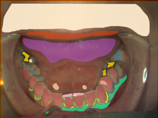 False color image render of a spectral image exhibiting attached gingiva, attrition/erosion, enamel, gingivitis, lip, marginal gingiva, metal, microfracture, oral mucosa, plaque, plastic, skin, specular reflection and tongue