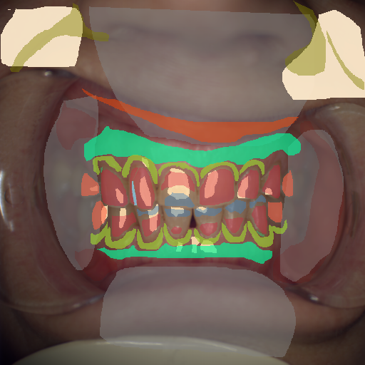 False color image render of a spectral image exhibiting attached gingiva, enamel, lip, marginal gingiva, microfracture, oral mucosa, out of focus area, plastic, prosthetics, root, shadow/noise, skin and specular reflection