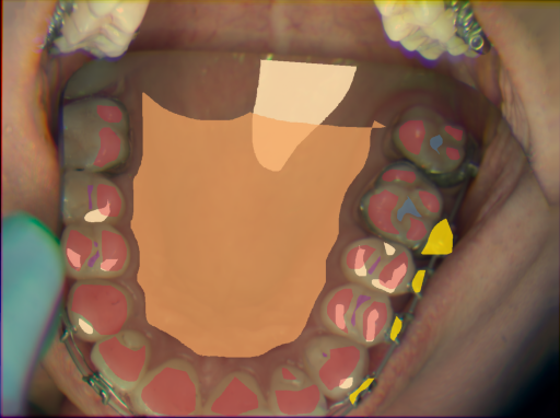 False color image render of a spectral image exhibiting enamel, hard palate, initial caries, metal, plastic and specular reflection
