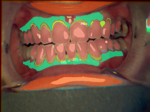 False color image render of a spectral image exhibiting attached gingiva, enamel, gingivitis, initial caries, lip, marginal gingiva, oral mucosa, plaque and specular reflection
