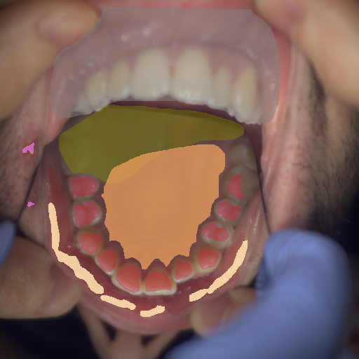 False color image render of a spectral image exhibiting enamel, hard palate, oral mucosa, out of focus area, shadow/noise, specular reflection and ulcer