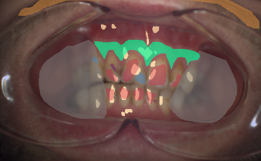 False color image render of a spectral image exhibiting attached gingiva, enamel, hair, initial caries, oral mucosa, out of focus area, plastic, skin, specular reflection and stain