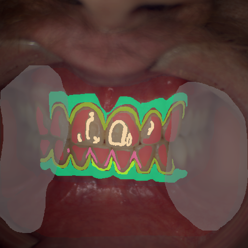 False color image render of a spectral image exhibiting attached gingiva, calculus, enamel, gingivitis, marginal gingiva, oral mucosa, out of focus area and specular reflection