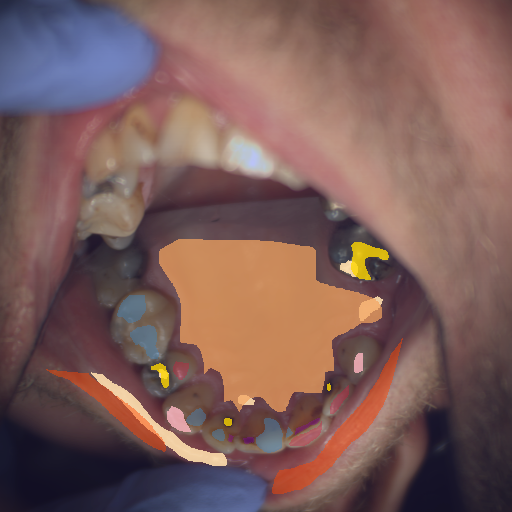 False color image render of a spectral image exhibiting attrition/erosion, enamel, hard palate, initial caries, lip, metal, plastic and specular reflection