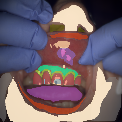 False color image render of a spectral image exhibiting attached gingiva, enamel, inflammation, lip, marginal gingiva, microfracture, oral mucosa, out of focus area, plastic, shadow/noise, skin, specular reflection, tongue and ulcer