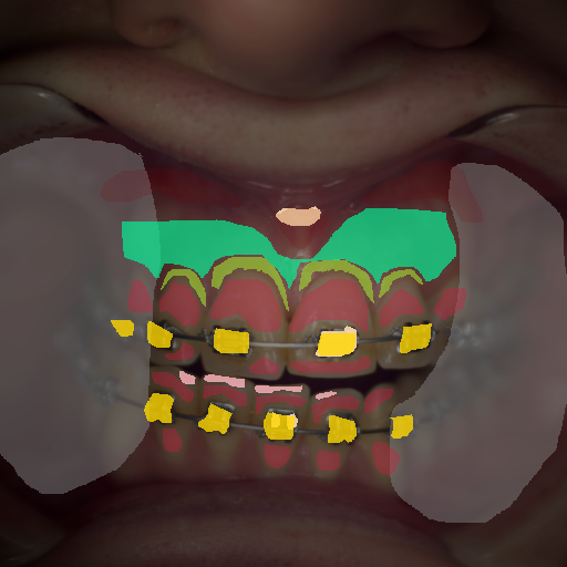 False color image render of a spectral image exhibiting attached gingiva, attrition/erosion, enamel, marginal gingiva, metal, oral mucosa, out of focus area and specular reflection